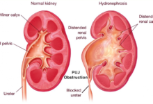 تصنيع الوصل الحويضي الحالبي